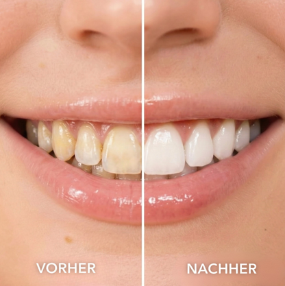 Unrealé Smile Refiner™ Pre Order
